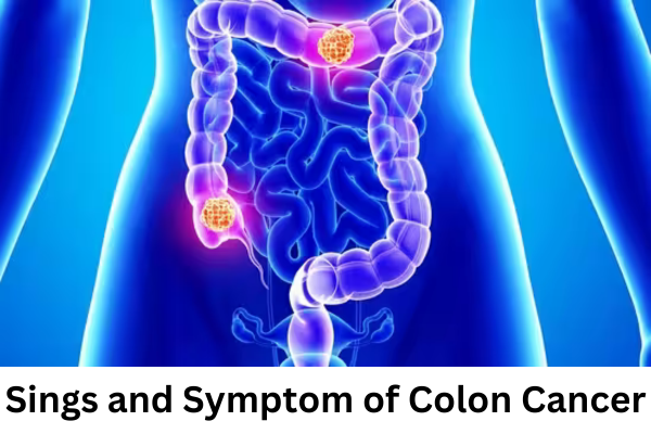 Colon Cancer